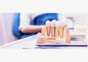 Ортопедическая стоматология: протезирование зубов качественно и надежно